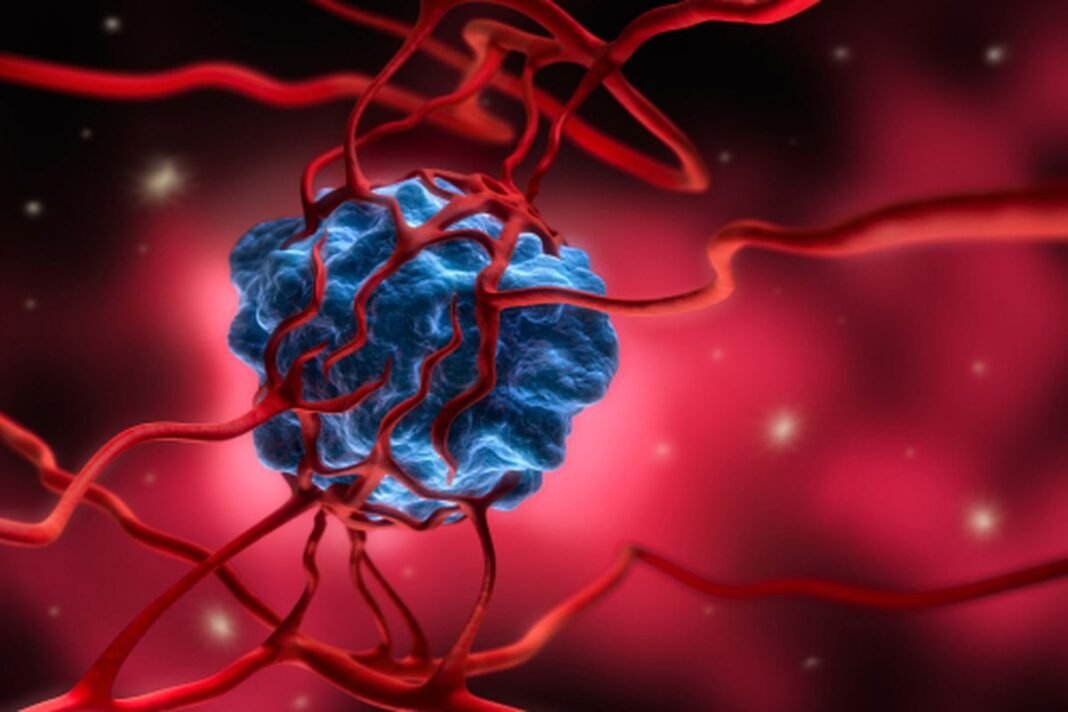 Waspadai Gejala Ini, Bisa Jadi Tanda Awal Kanker yang Sering Diabaikan!